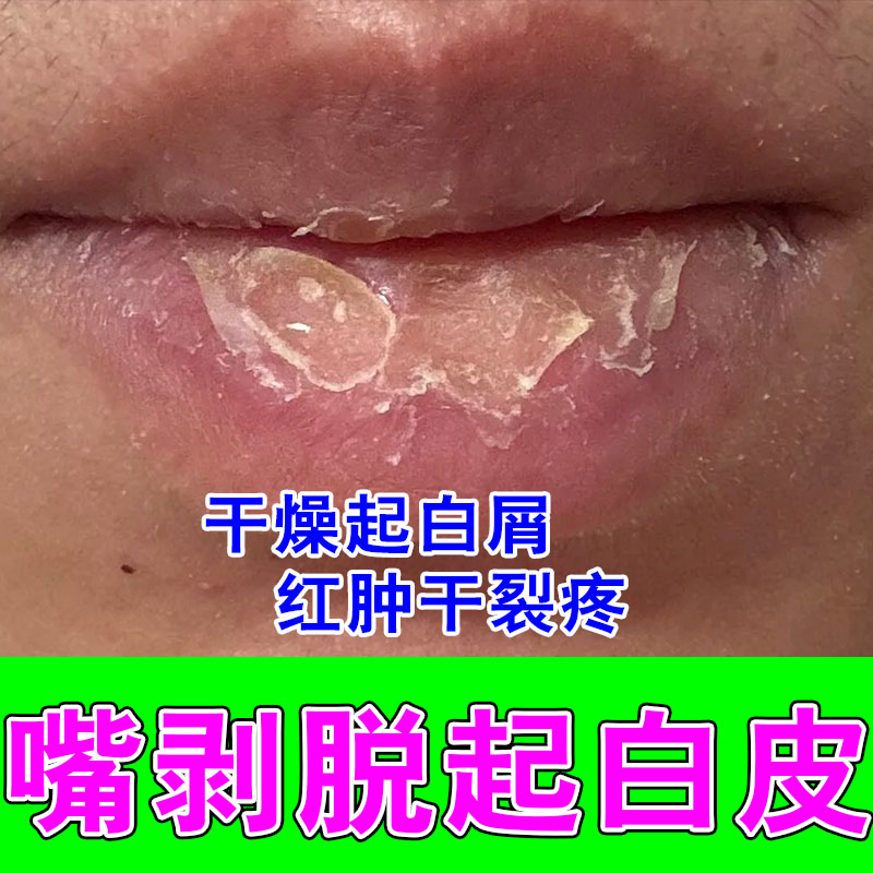 冶唇专用唇膏防嘴唇干裂脱皮用型儿童修复剥脱性润唇药