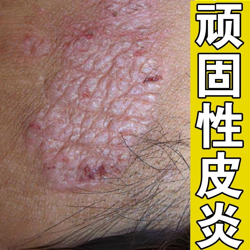治疗神经性皮肤炎外用膏脖子身上全身到处发痒起皮真菌感染专用膏