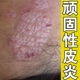 治疗神经性皮肤炎外用膏脖子身上全身到处发痒起皮真菌感染专用膏