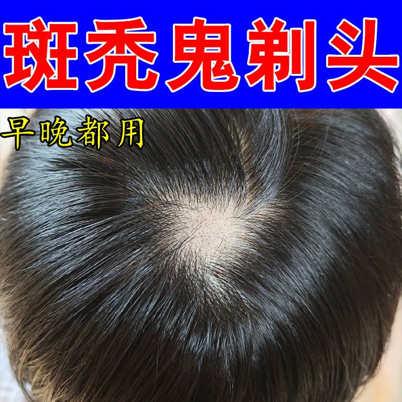 斑秃头毛囊稀疏发量不足头顶头掉发后脑勺大面积深层修护草本喷剂