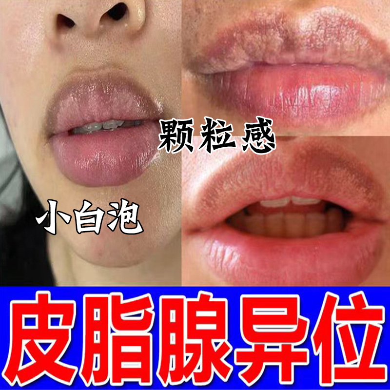 皮脂腺异位嘴唇白点小颗粒润唇膏