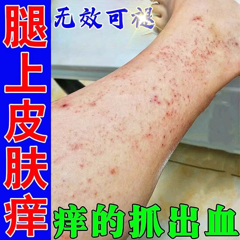 夏季腿痒小腿皮肤干燥红痒腿上长红点点腿痒刺挠止痒抑菌软膏