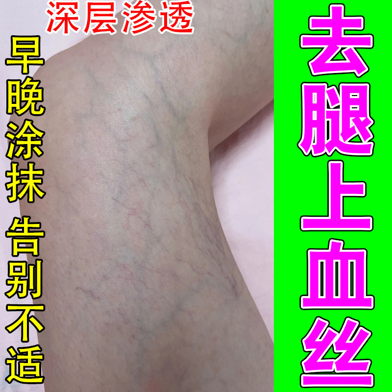 腿上的红血丝皮肤血管扩张修复腿上血丝青筋凸起屏障舒缓保乳膏