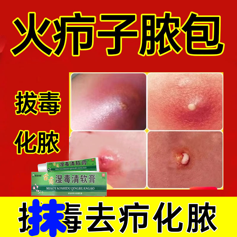 云南本草火疖子拔毒拔脓膏皮脂腺囊肿硬块痘痘拔脓贴屁股坐板疮膏