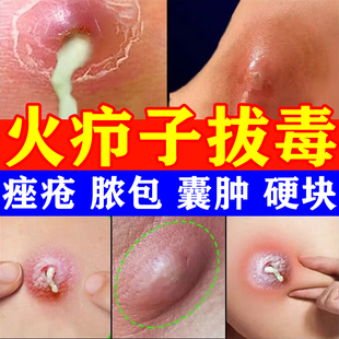 火疖子拔毒拔脓膏药贴治疗屁股上长痘痘痒起热疙瘩硬块吸脓头粉瘤