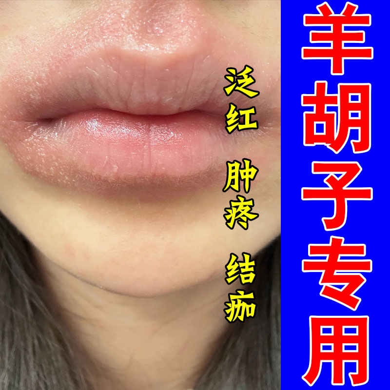 改善舔嘴引发口周泛红结痂羊胡子干疼起皮不适保湿植物膏