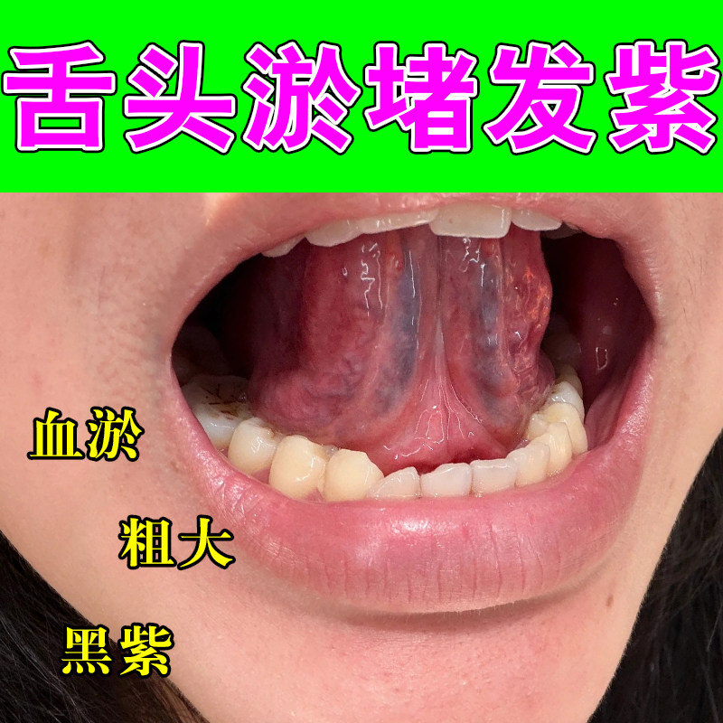 舌下青筋又黑又粗舌头底黑紫血管淤血疏通活血肝火旺草本舒缓喷剂