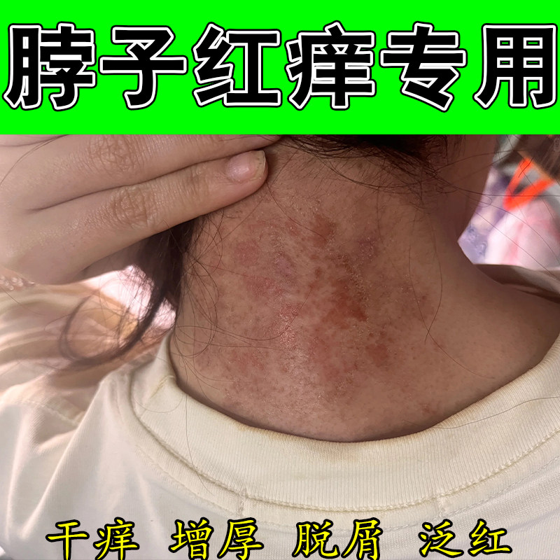 脖子上皮肤起粗糙疙瘩泛红身上干燥刺挠痒起皮神经性起皮修护膏