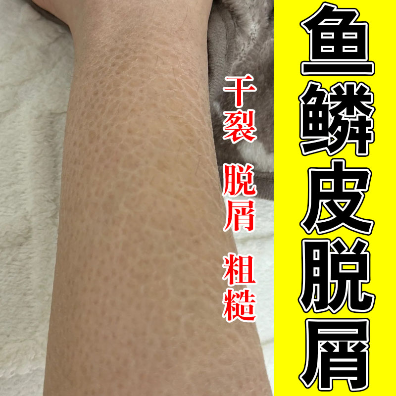 小腿鱼鳞肤干燥起皮裂纹掉皮屑润肤粗糙长效保湿滋养甘油