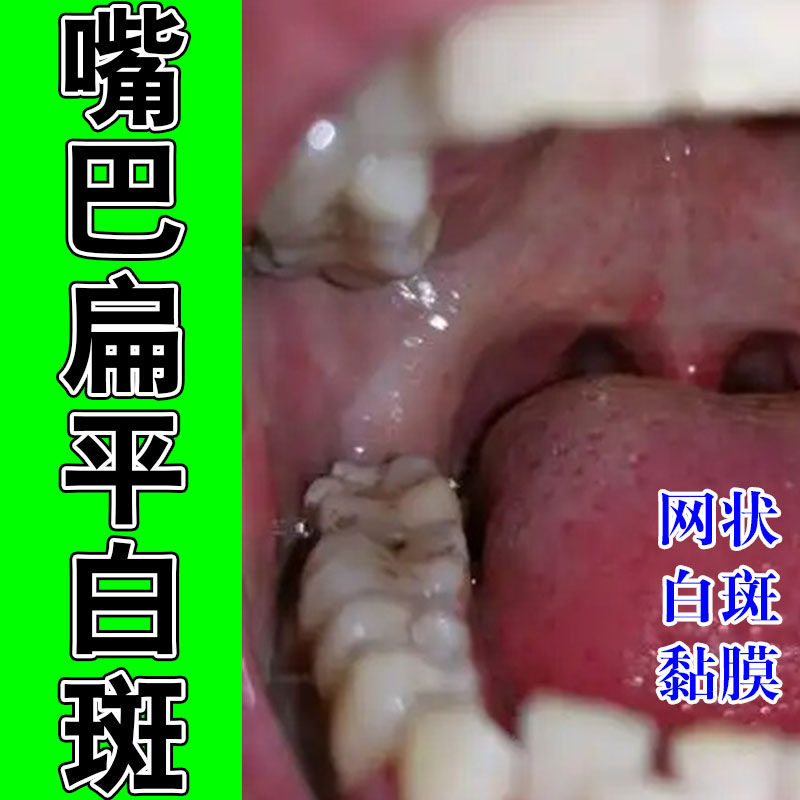 口腔扁平化黏膜白斑黏膜白斑舌头纤维化黏膜白色修护植物喷剂