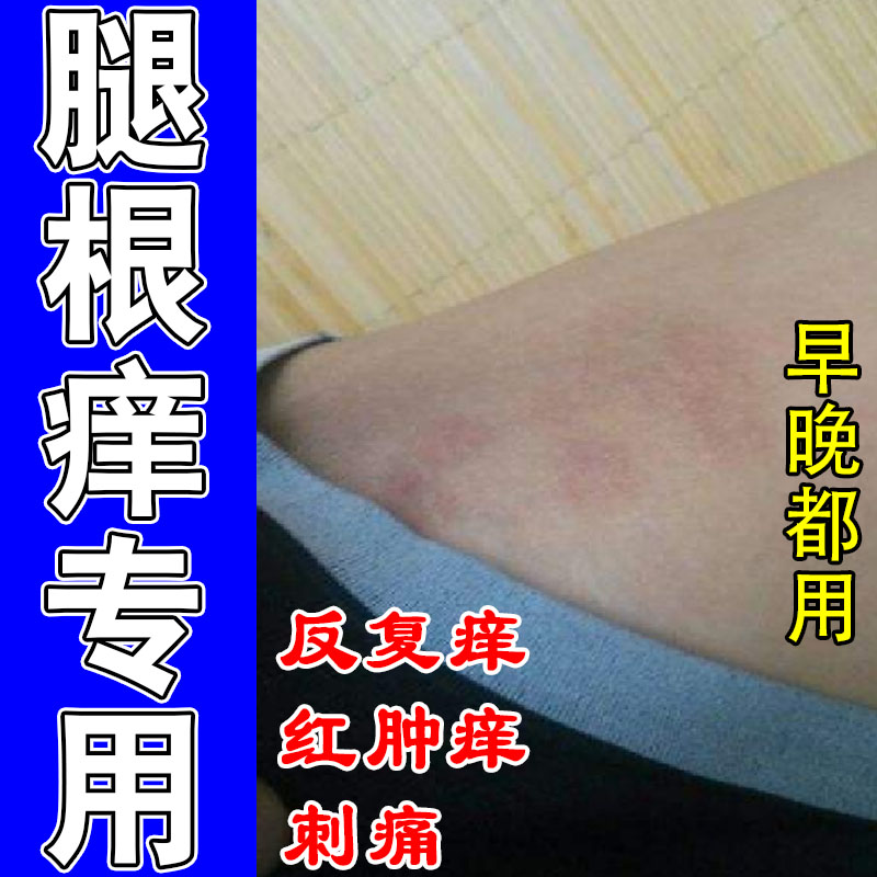 屁股大腿内侧皮肤痒大腿两侧潮湿红斑粗糙疙瘩发痒起皮屑修护膏