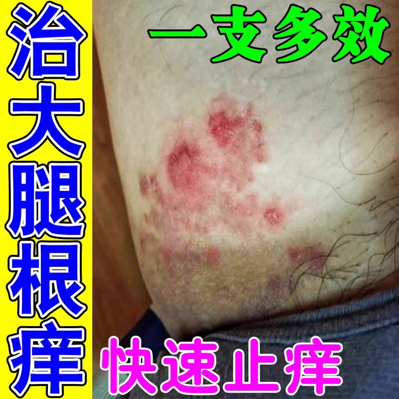 大腿内侧湿疹皮肤瘙痒止痒抑菌膏