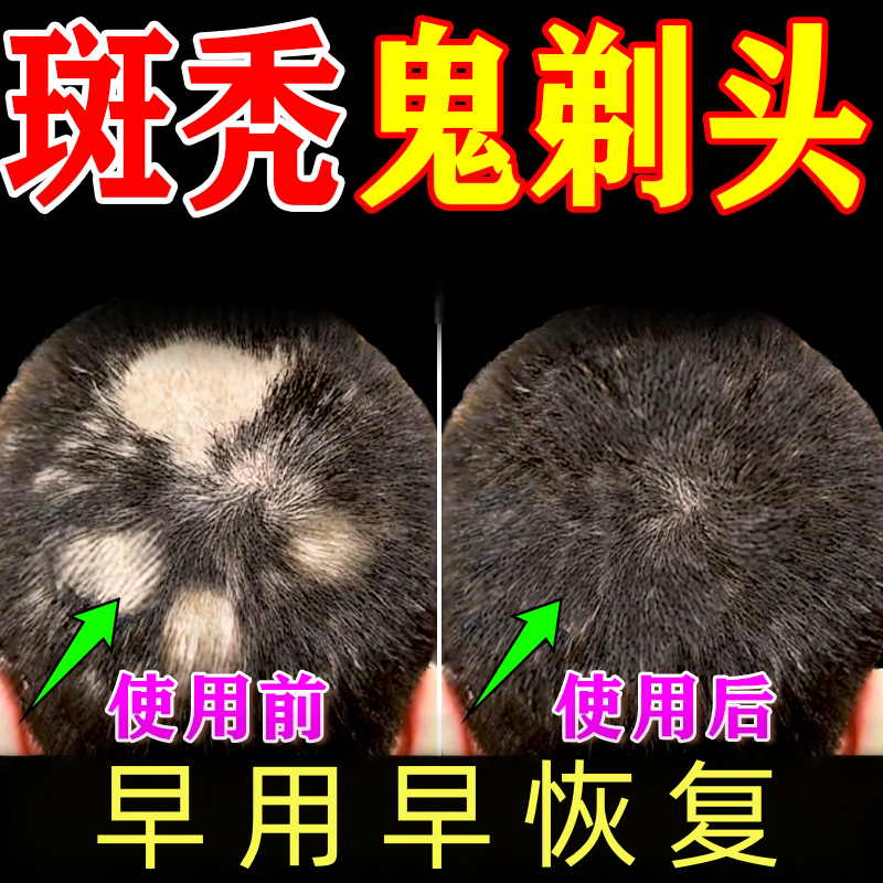 斑秃非效特脂溢性皮炎软膏鬼剃头遮盖防脱洗发水生发液专用治疗剂