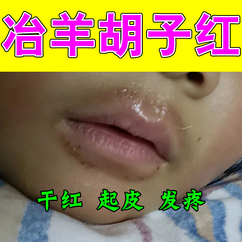 儿童嘴巴泛红结痂羊胡子疼起皮粗糙爱舔嘴草本保湿修护膏