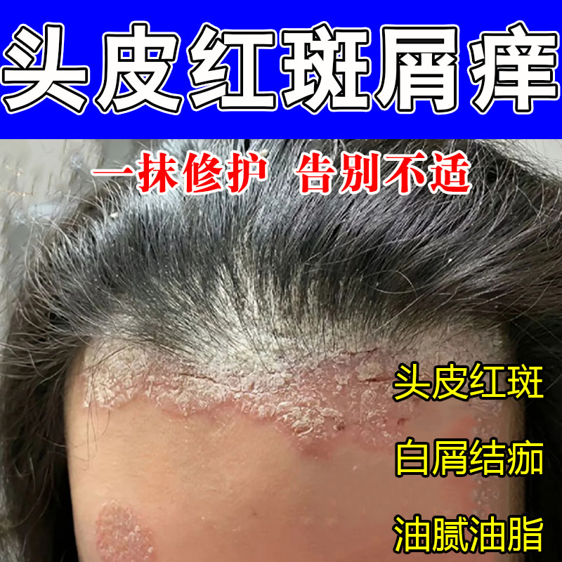 头皮红斑痒脱屑白屑起皮干燥粗糙发痒泛红头部肌肤舒缓保湿植物膏