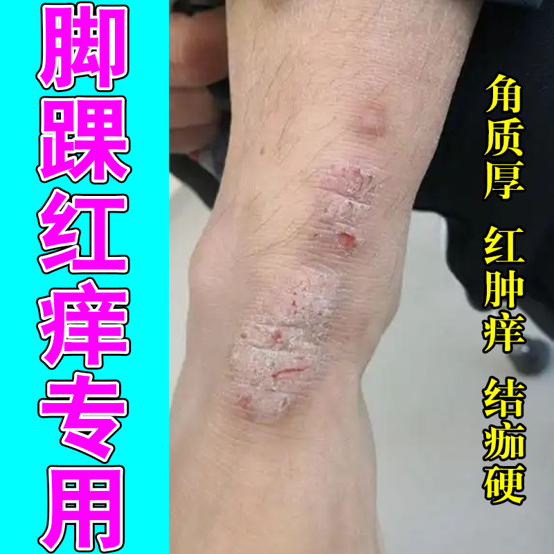 脚踝泛红痒起疙瘩皮肤干燥粗糙刺挠脚脖子长红斑脚踝发痒修复膏乳