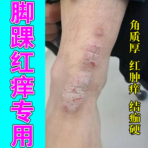 脚踝泛红痒起疙瘩皮肤干燥粗糙刺挠脚脖子长红斑脚踝发痒修复膏乳