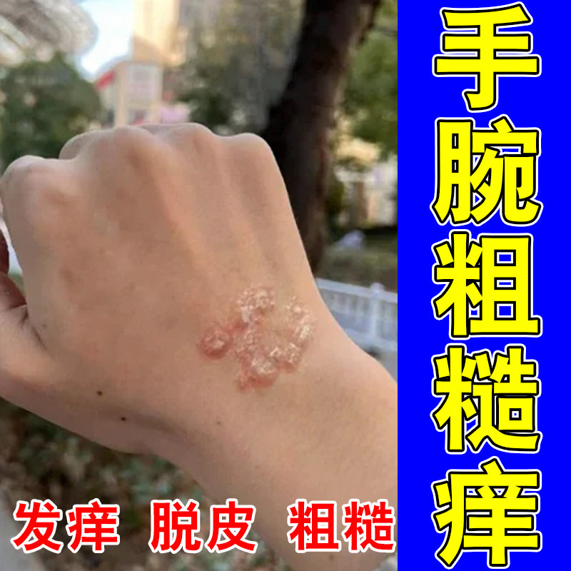 手腕关节处干燥起皮屑双手粗糙发痒神经性痒草本修护保湿膏