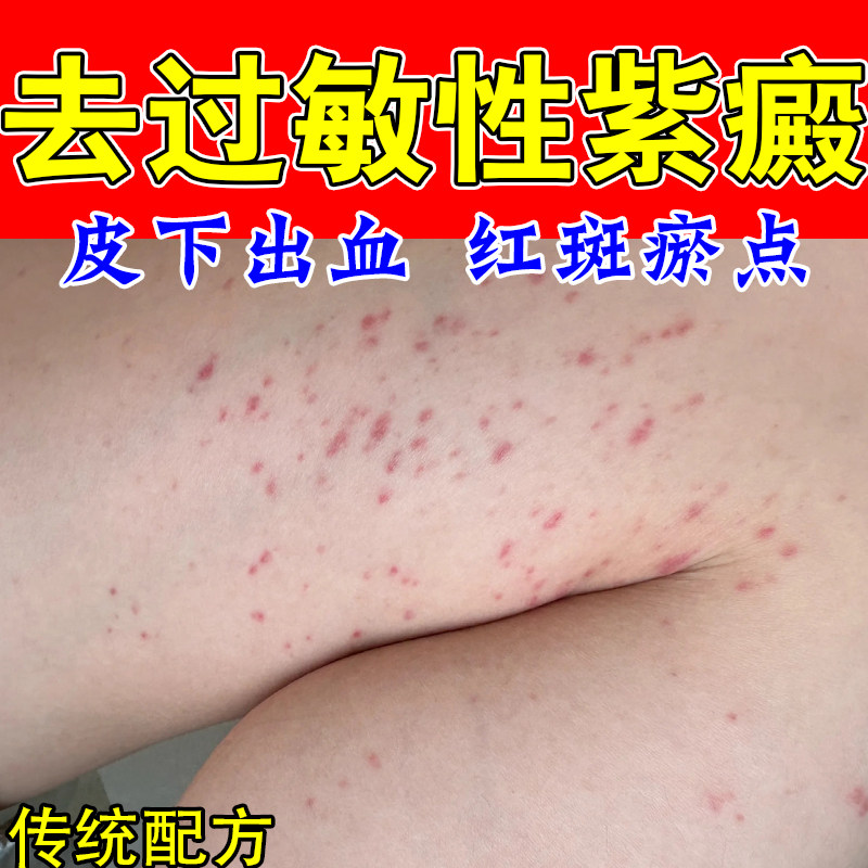 消腿上紫斑淤点舒缓淡化手上色素沉淀红点瘀斑血管红点软膏