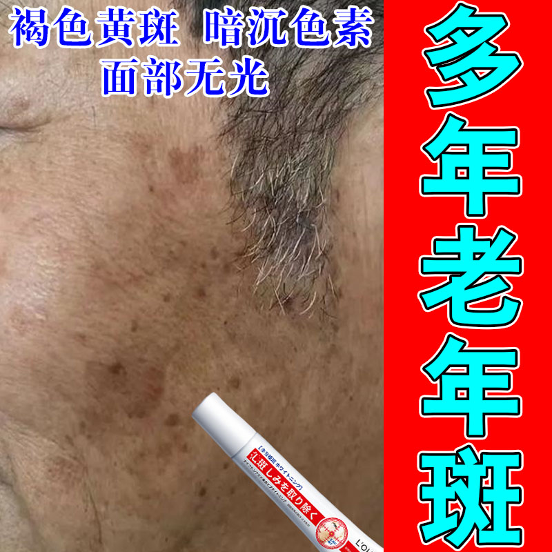 老人脸上斑点暗沉斑脸部黄斑日晒黑斑皮肤上黑斑草本萃取修护膏