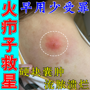 火疖子膏皮下火疖子硬块疙瘩脓包膏药