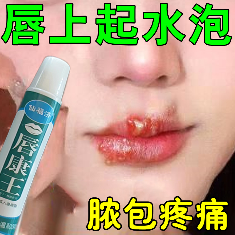 嘴唇起水泡烂嘴角起水泡嘴巴上火嘴巴脓包疼痛口红肿发痒上火起泡