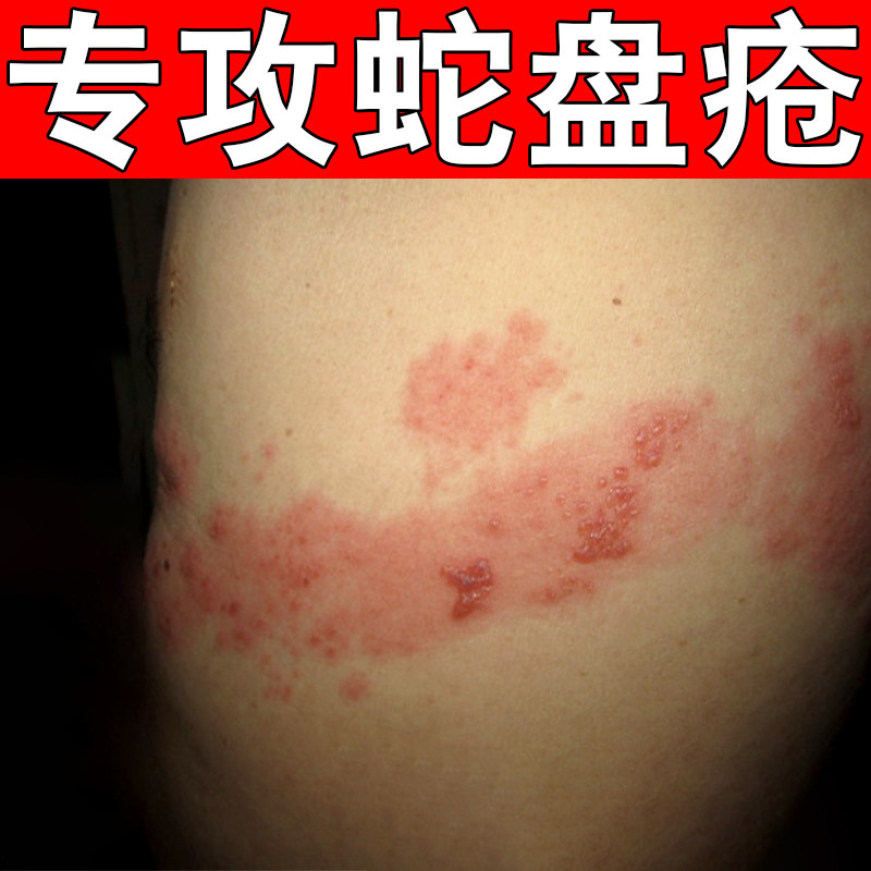 蛇盘皮肤蛇胆蛇缠腰疼痛干缠腰火身上起红疙瘩软膏