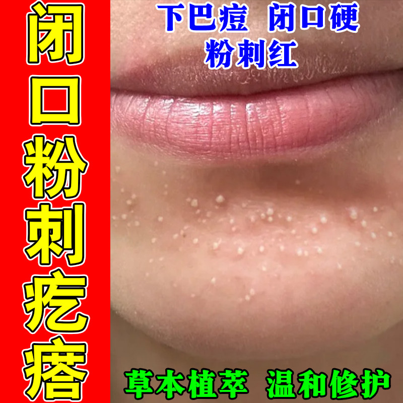 粉刺闭口脸部敏感长痘起小疙瘩逆光疙瘩下巴额头痘红修护软膏