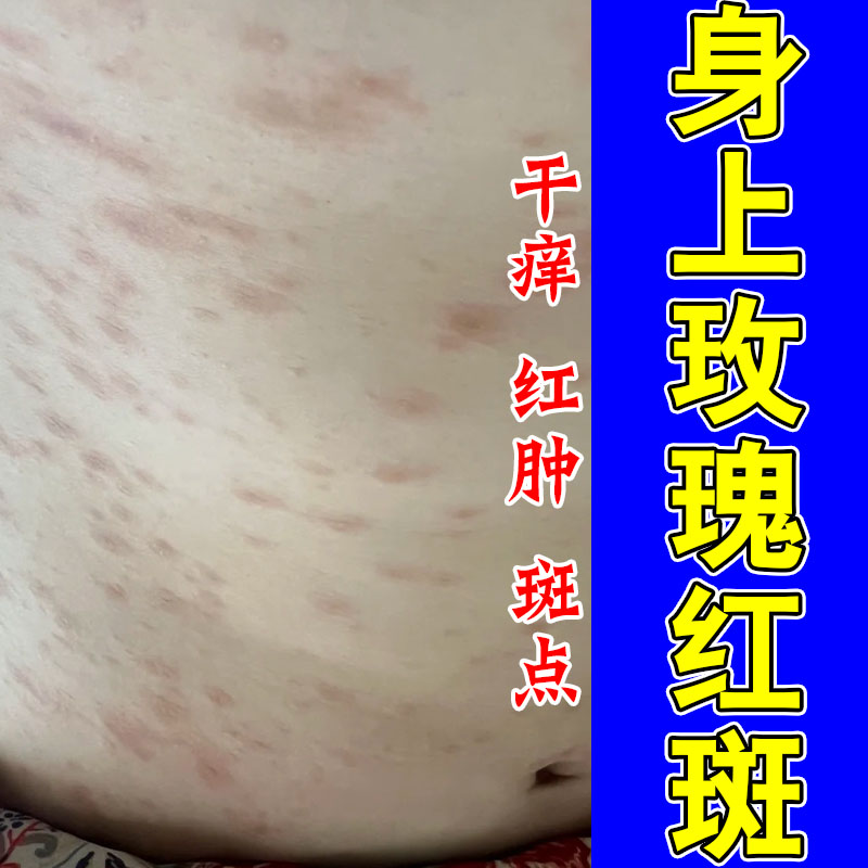 玫瑰红斑身上皮肤痒起红斑疙瘩干燥掉皮粗糙过敏保湿修护软膏