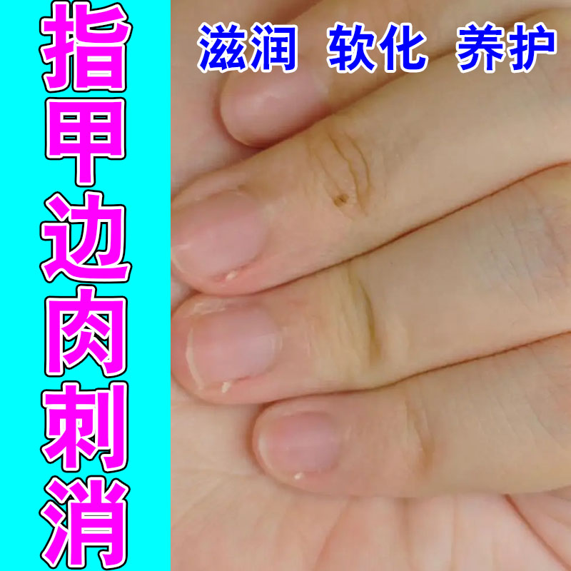 手指起倒刺手足脱皮肉刺手指头起皮肉刺出血指甲边缘修护保湿膏
