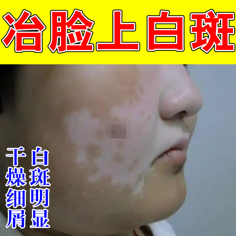 去脸上长白斑成人脸上有小白点白色斑块白块痒快速消白斑专用膏