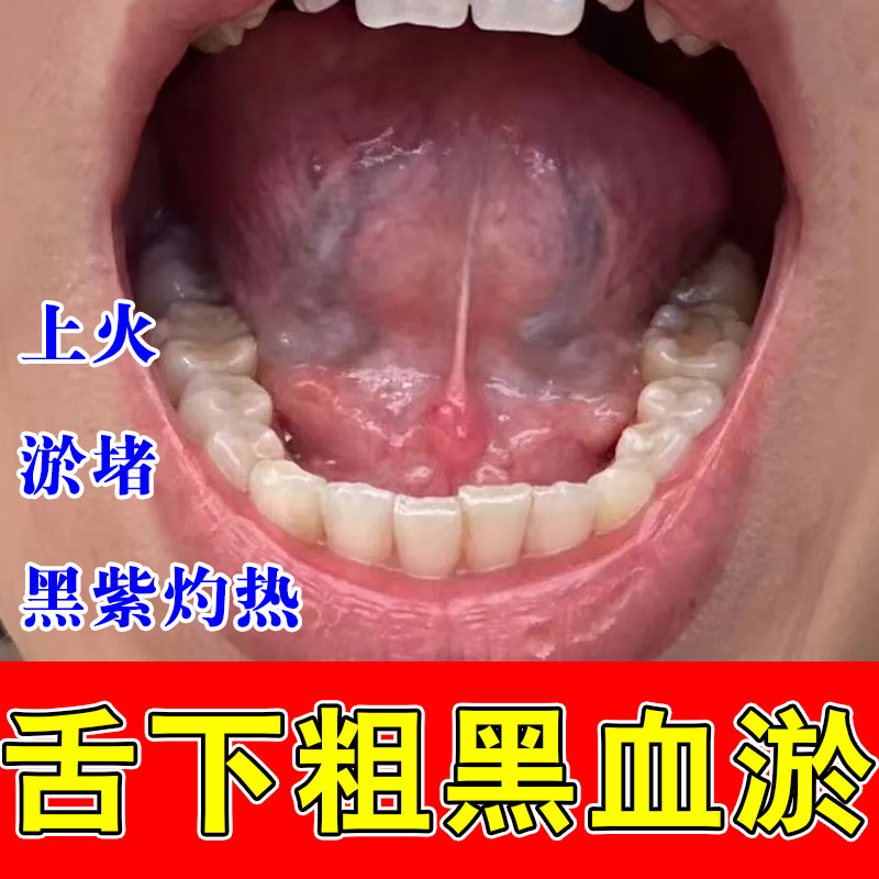 舌底黑紫血管粗大胀痛舌下青筋红肿不适淤血严重堵草本修护喷剂