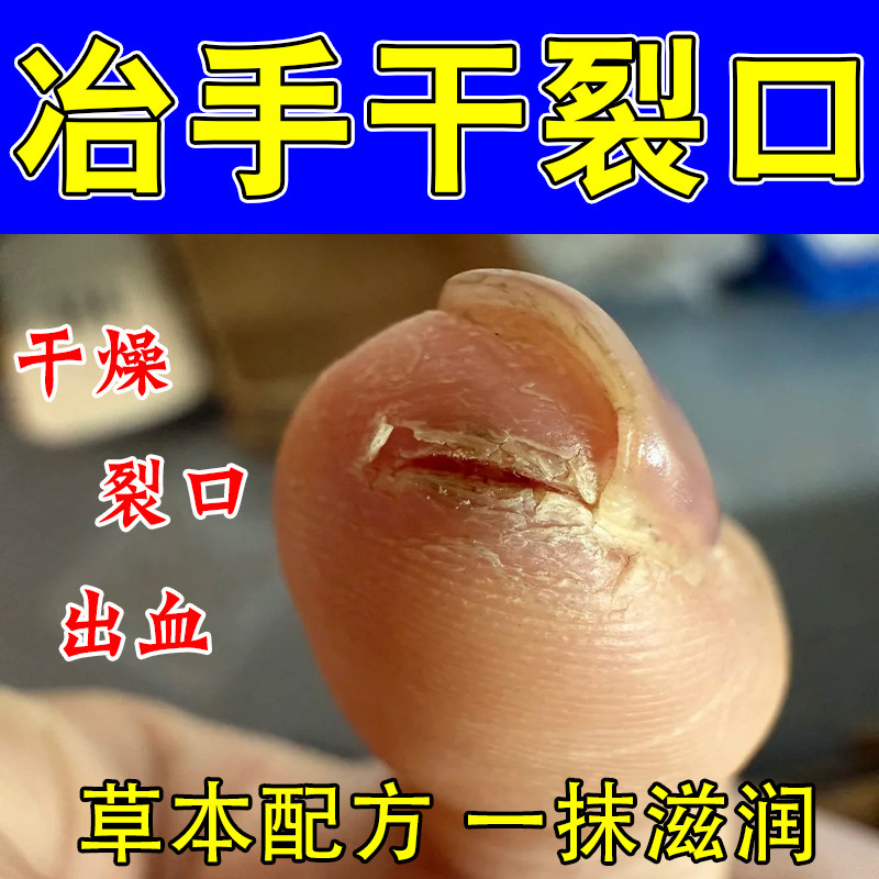 手指头裂口子脱皮开裂手裂脱屑粗糙真菌干燥裂口舒缓修护膏