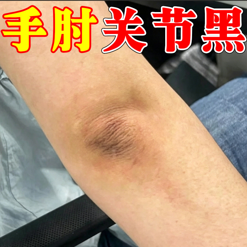 手肘关节黑夏天脖子黑全身去胳膊肘黑色素沉淀黑棘皮神器