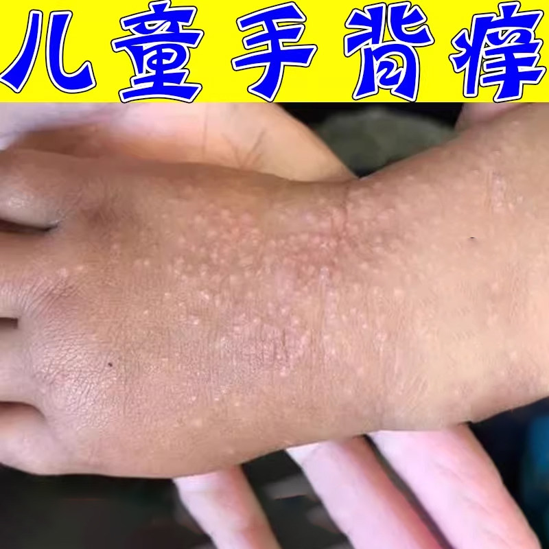 儿童手上起疙瘩皮晒伤起小点手背皮肤消毒护理（消）