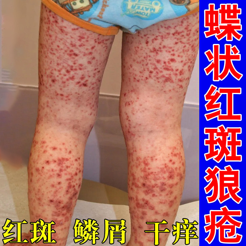 冶疗蝶状性系统性急慢性红斑狼疮乳膏全身软膏