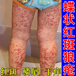 冶疗蝶状性系统性急慢性红斑狼疮乳膏全身软膏