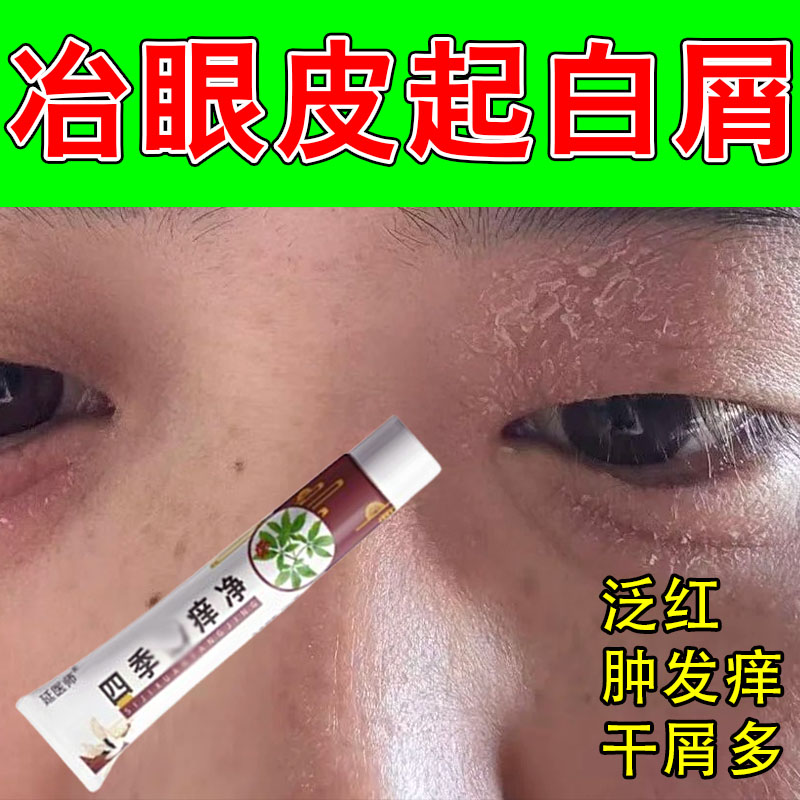 眼皮过敏干燥起屑神经性眼睛周围眼皮上干痒粗糙起皮痒草本修护膏