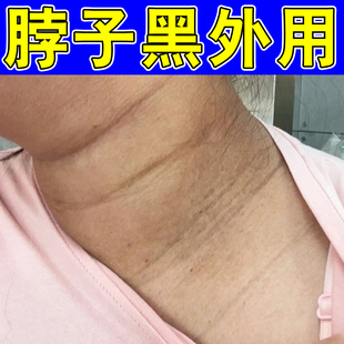 脖子黑春夏天气热身上皮肤晒黑儿童黑棘皮膝盖关节手肘黑色素沉淀