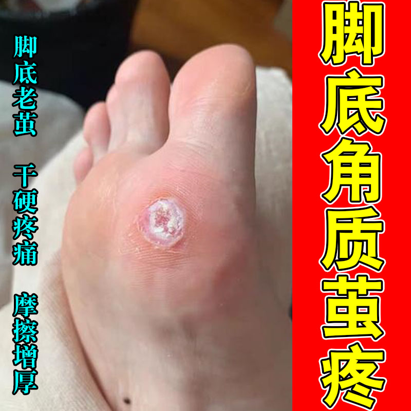 足部老茧厚茧硬茧脚底角质发黄发硬脚茧脚部肌肤舒缓膏贴