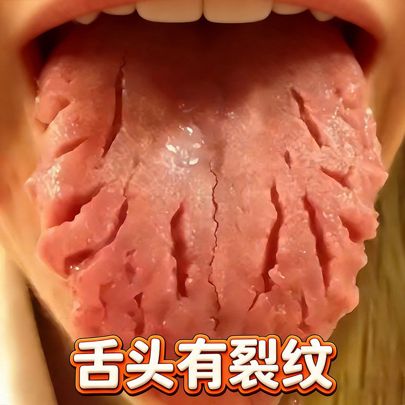 舌头中间裂纹有齿痕舌苔白厚黄腻地图舌舌开裂疼痛外用喷雾剂