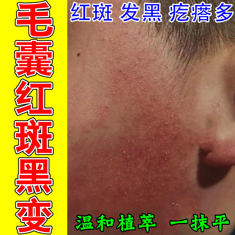 毛囊红斑黑变脸颊毛囊粗糙疙瘩暗沉脸毛周角化泛红黑粗糙修护膏