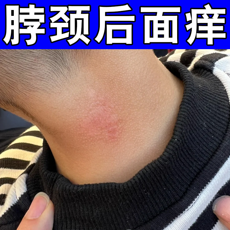 脖颈后面痒长红斑小疙瘩皮肤干燥粗糙一挠就痒外用脖子过敏痒乳膏