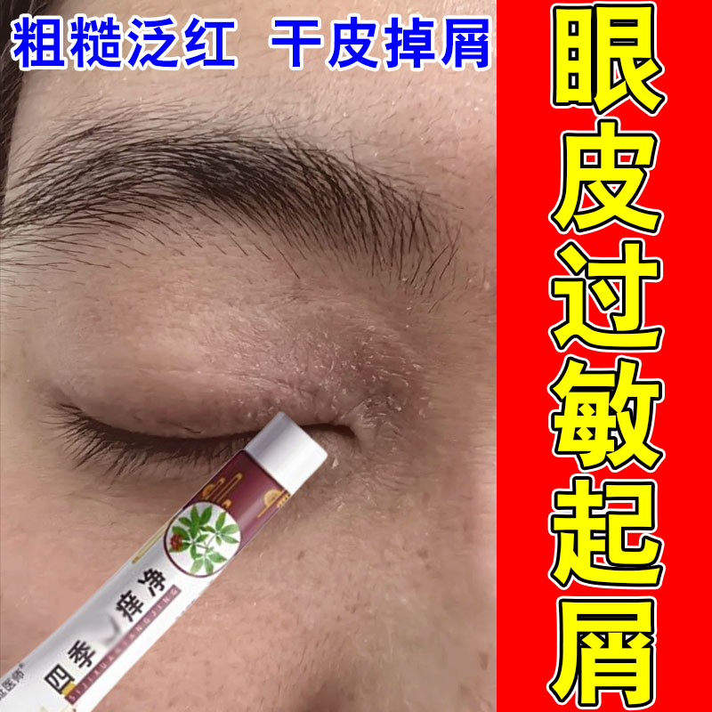 眼皮眼睛周围眼角痒粗糙起皮红肿干燥起皮掉屑神经性修复保湿软膏