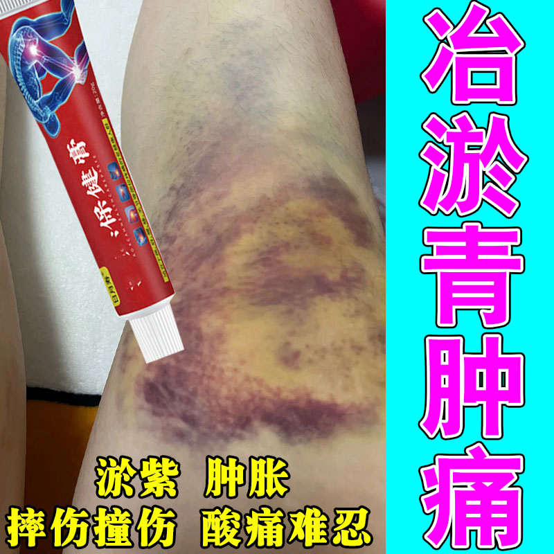 身上淤青撞伤活血化瘀磕碰撞伤摔伤发紫皮下淤血淤外用修护膏