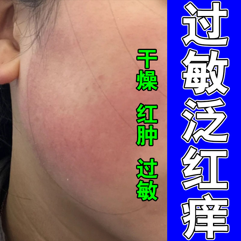 过敏脸部皮肤晒伤泛红痒刺痛肿热明显草本舒缓保湿膏