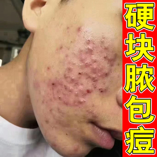 脸颊长痘痘硬块脓包痘青春痘脸上起疙瘩痘学生青春痘男女外用乳膏