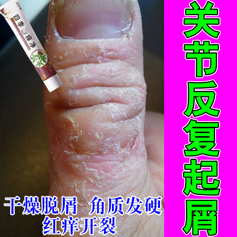 手指关节痒硬皮手指关节长硬疙瘩神经性手指开裂粗糙掉皮发痒软膏