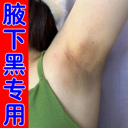 腋下黑专用手肘胳膊关节膝盖皮肤发黑修复脖子黑色素沉淀黑棘皮膏