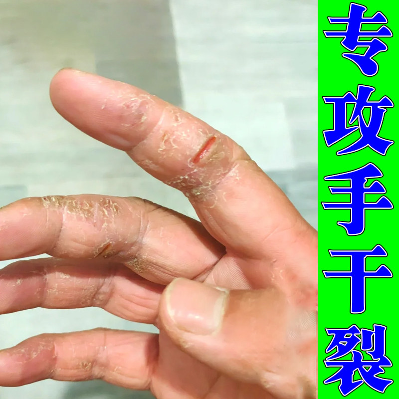 手裂口干裂修复霜秋冬季指甲缝干裂手指干燥裂手足干裂膏
